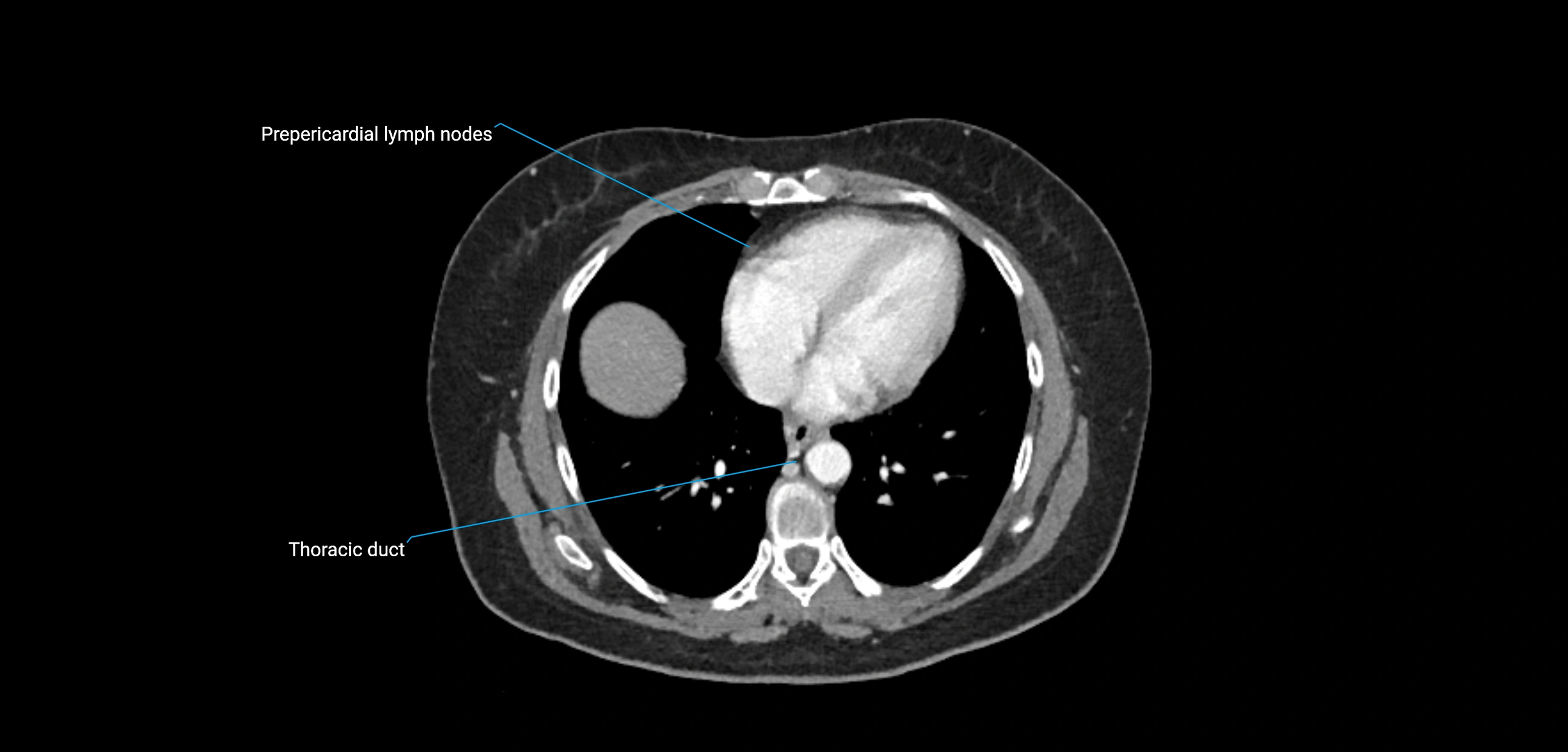 CT ct abdominal lymph nodes  axial cross sectional anatomy  enchanced radiology image -img-00002-00049.webp